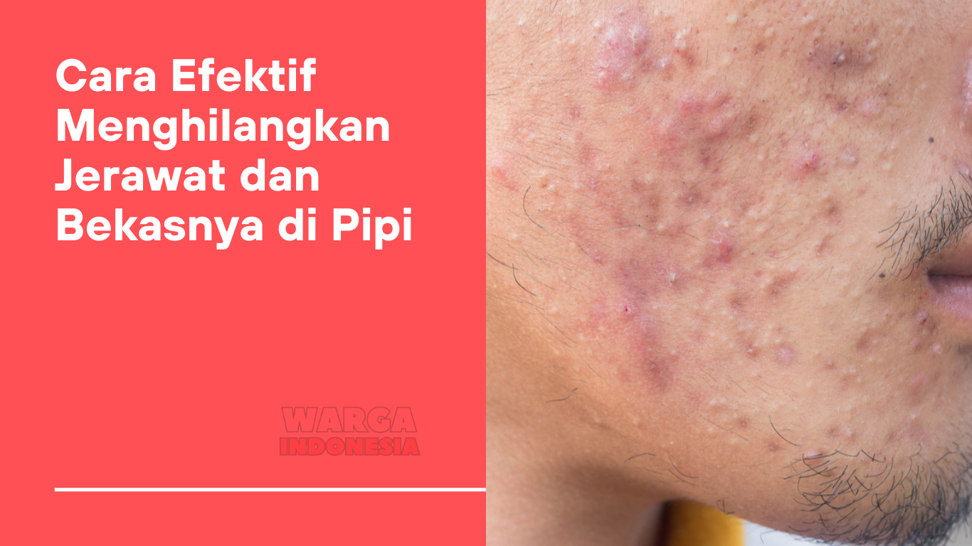 Cara Efektif Menghilangkan Jerawat dan Bekasnya di Pipi