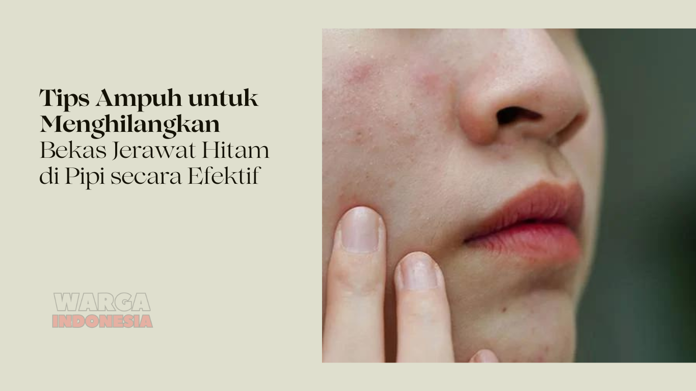 Tips Ampuh untuk Menghilangkan Bekas Jerawat Hitam di Pipi secara Efektif