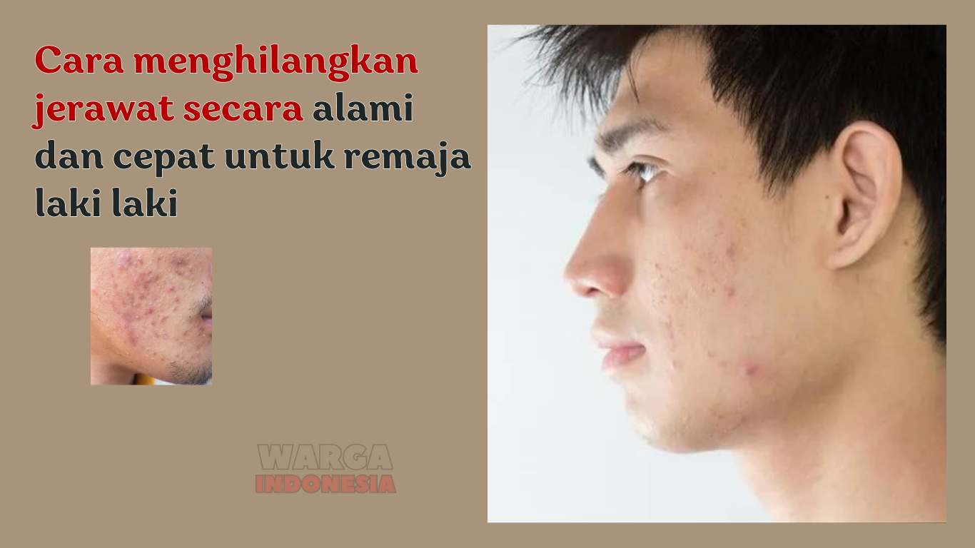 Cara Menghilangkan Jerawat Secara Alami dan Cepat untuk Remaja Laki-laki