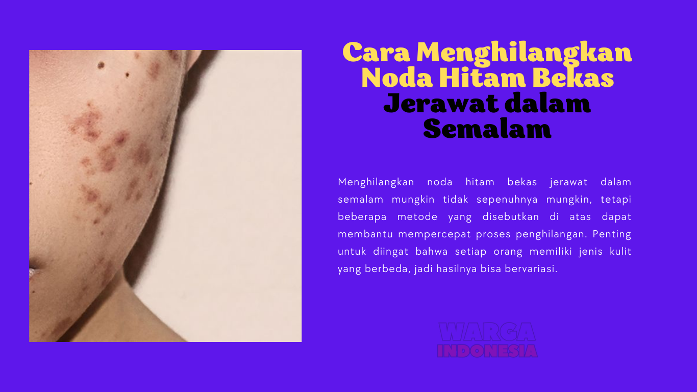 Cara Menghilangkan Noda Hitam Bekas Jerawat dalam Semalam