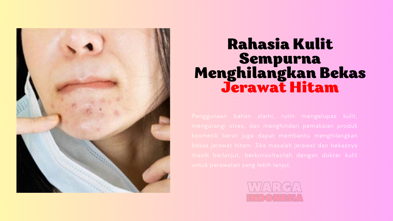 Rahasia Kulit Sempurna Menghilangkan Bekas Jerawat Hitam